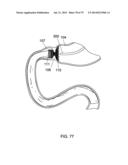 GASTROINTESTINAL PROSTHESES diagram and image