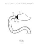 GASTROINTESTINAL PROSTHESES diagram and image