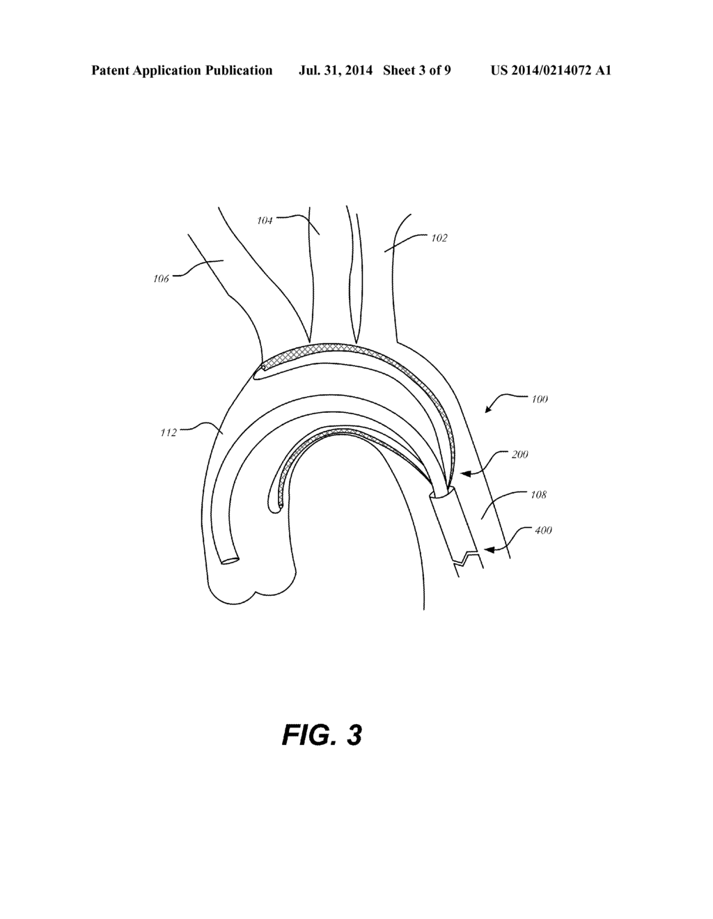 AORTIC GREAT VESSEL PROTECTION - diagram, schematic, and image 04