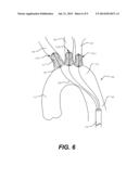 AORTIC GREAT VESSEL PROTECTION diagram and image