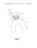 AORTIC GREAT VESSEL PROTECTION diagram and image