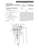 DISTAL RADIUS VOLAR LOCKING PLATE WITH EXTENSION FOR ULNAR VOLAR FRAGMENT diagram and image