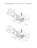 BONE FIXATION SYSTEMS AND METHODS OF USE diagram and image