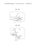 METHOD AND DEVICE FOR HEART VALVE REPAIR diagram and image