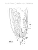 Transdermal Intraosseous Device diagram and image