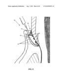 PERIODONTAL TREATMENT SYSTEM AND METHOD diagram and image