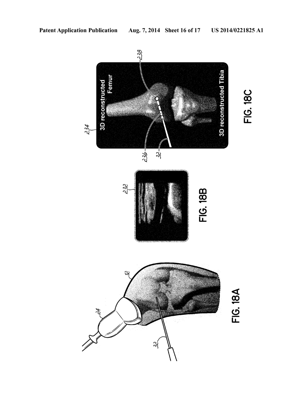 Real-Time 3-D Ultrasound Reconstruction of Knee and Its Implications For     Patient Specific Implants and 3-D Joint Injections - diagram, schematic, and image 17