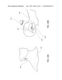 BLOOD VESSEL SIZING DEVICE diagram and image