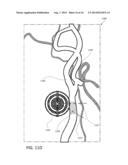 BLOOD VESSEL SIZING DEVICE diagram and image