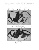 ROTATION AND ABDUCTION DEVICE FOR SHOULDER IMMOBILIZATION diagram and image