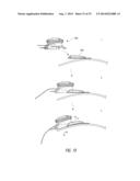 CLOSURE DEVICES FOR MEDICAL DEVICES AND METHODS diagram and image