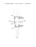 Brace For Unloading Of Medial Or Lateral Joint diagram and image