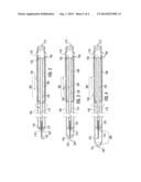 Surgical Aspiration and Irrigation diagram and image