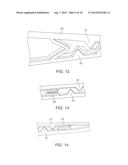 NEEDLE FOR DELIVERY OF DERMAL FILLER THREADS diagram and image