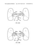 APPARATUS AND METHODS FOR TREATING PULMONARY HYPERTENSION diagram and image