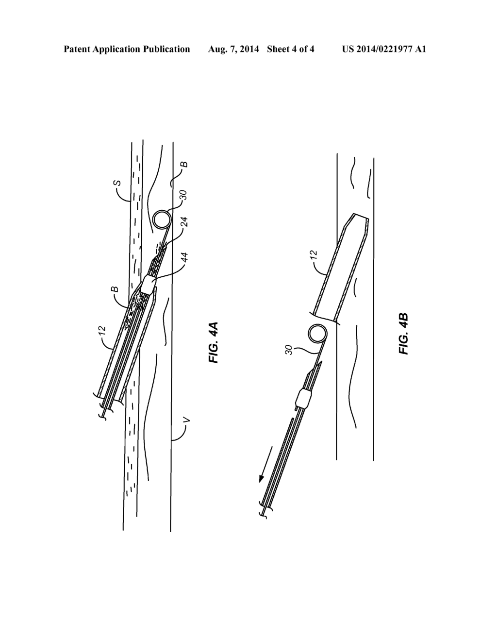 SYSTEMS AND METHODS FOR NEEDLE AND CATHETER ADVANCEMENT - diagram, schematic, and image 05