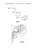 IMPLANTABLE DEVICE WITH INTRAVESICAL TOLERABILITY AND METHODS OF TREATMENT diagram and image