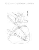 Laparoscopic Instruments, Attachable End Effectors And Methods Relating To     Same diagram and image