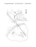 Laparoscopic Instruments, Attachable End Effectors And Methods Relating To     Same diagram and image