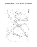 Laparoscopic Instruments, Attachable End Effectors And Methods Relating To     Same diagram and image