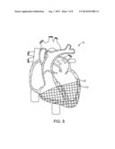 METHODS AND DEVICES FOR DIASTOLIC ASSIST diagram and image