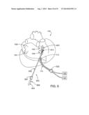 CARDIAC ABLATION DEVICES AND METHODS diagram and image