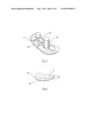 METHOD OF ARTHROPLASTY ON A KNEE JOINT AND APPARATUS FOR USE IN SAME diagram and image