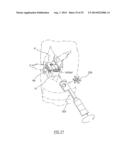 METHOD OF ARTHROPLASTY ON A KNEE JOINT AND APPARATUS FOR USE IN SAME diagram and image