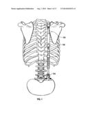 BONE SUPPORT APPARATUS diagram and image