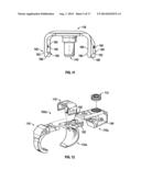 BONE SUPPORT APPARATUS diagram and image