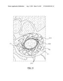 Heart Valve Prosthesis diagram and image