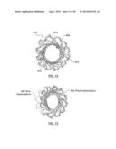 Heart Valve Prosthesis diagram and image