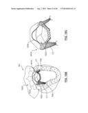 Heart Valve Prosthesis diagram and image