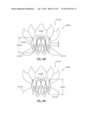 Heart Valve Prosthesis diagram and image