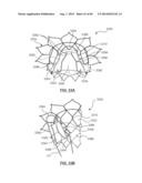 Heart Valve Prosthesis diagram and image