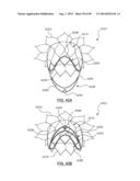 Heart Valve Prosthesis diagram and image