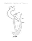 Heart Valve Prosthesis diagram and image