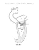 Heart Valve Prosthesis diagram and image