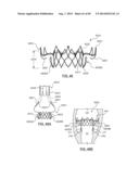 Heart Valve Prosthesis diagram and image