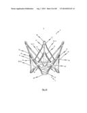 MEDICAL DEVICE FOR TREATING A HEART VALVE INSUFFICENCY diagram and image