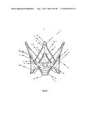 MEDICAL DEVICE FOR TREATING A HEART VALVE INSUFFICENCY diagram and image