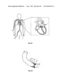 MEDICAL DEVICE FOR TREATING A HEART VALVE INSUFFICENCY diagram and image