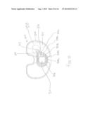 CEMENTLESS TIBIAL IMPLANT diagram and image