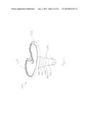 CEMENTLESS TIBIAL IMPLANT diagram and image