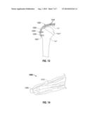 Reinforced Tissue Patch diagram and image