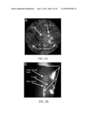 Self-Illuminated Handheld Lens for Retinal Examination and Photography and     Related Method thereof diagram and image