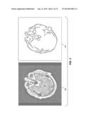 ANTERIOR COMMISSURE AND POSTERIOR COMMISSURE SEGMENTATION SYSTEM AND     METHOD diagram and image