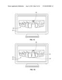 Patient-Specific Dental Prosthesis And Gingival Contouring Developed By     Predictive Modeling diagram and image