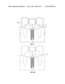 Patient-Specific Dental Prosthesis And Gingival Contouring Developed By     Predictive Modeling diagram and image