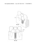 Patient-Specific Dental Prosthesis And Gingival Contouring Developed By     Predictive Modeling diagram and image